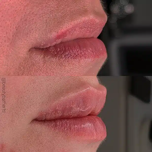 choosing right lip filler preactitioner Choosing right lip filler preactitioner
