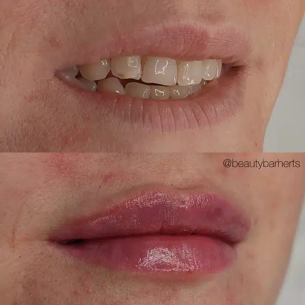 how to choose lip filler clinic in hertfordshire How to choose lip filler clinic in hertfordshire