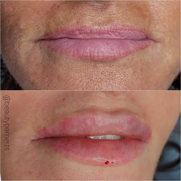 how to choose lip filler practitioner hertfordshire How to choose lip filler practitioner hertfordshire