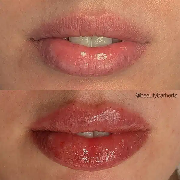 how to choose right aesthetician for lip filler How to choose right aesthetician for lip filler