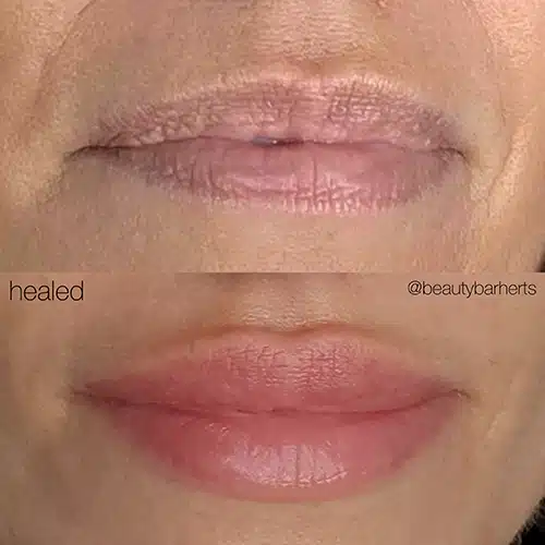 lip filler before and after near letchworth garden city Lip filler before and after near letchworth garden city