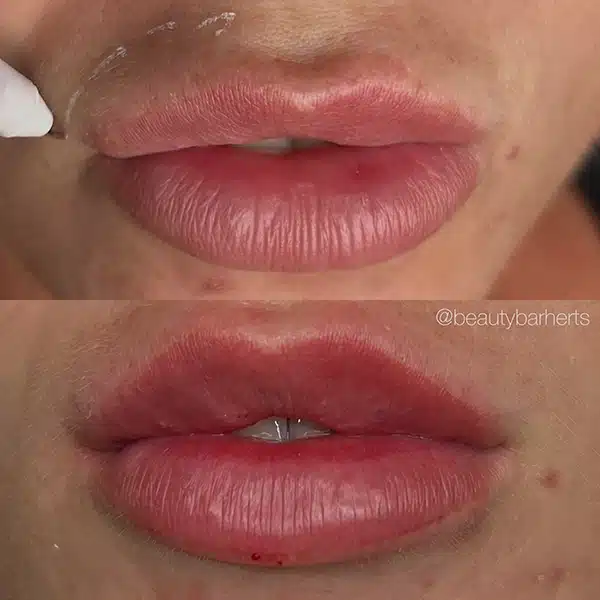Lip filler correction hertford