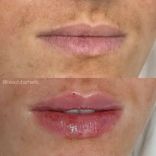 natural lip augmentation near letchworth garden city Natural lip augmentation near letchworth garden city
