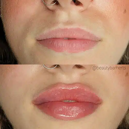 natural lip filler before after at beauty bar near letchworth garden city Natural lip filler before after at beauty bar near letchworth garden city