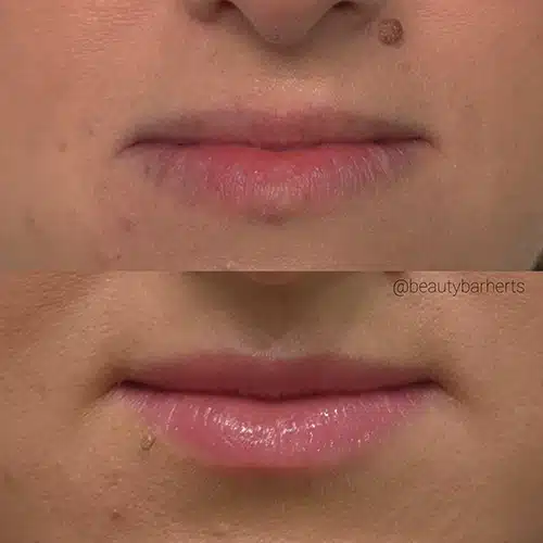 natural lip filler by beauty bar near letchworth garden city Natural lip filler by beauty bar near letchworth garden city