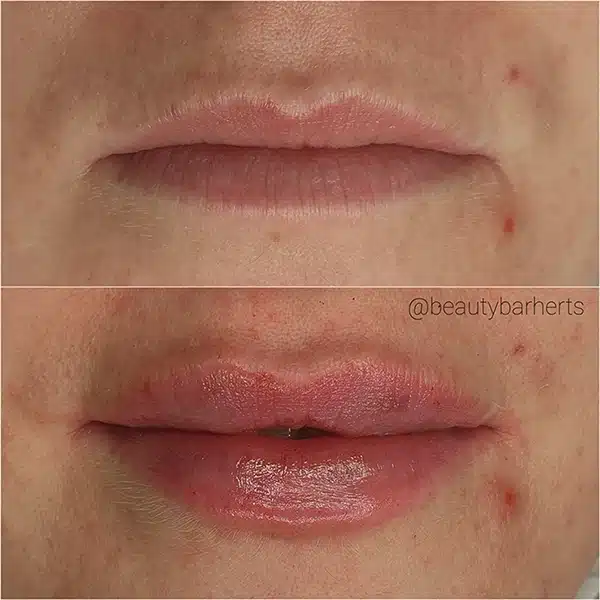 natural lip filler hertford before after Natural lip filler hertford before after