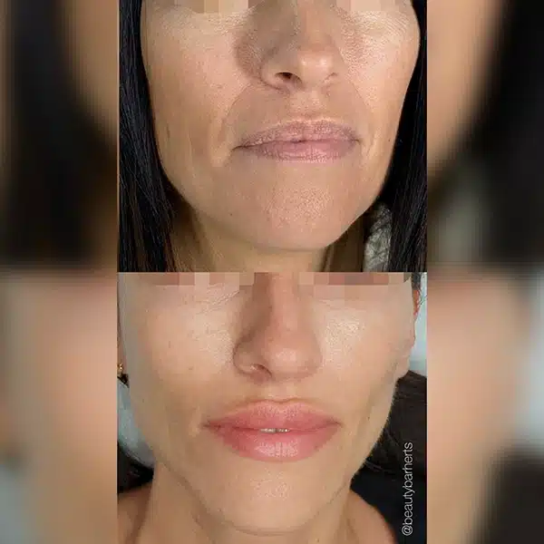 rf microneedling buntingford hertfordshire Rf microneedling buntingford hertfordshire