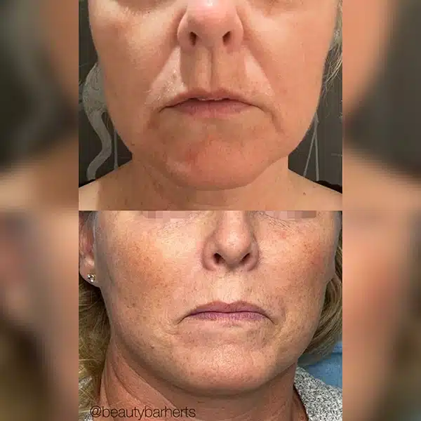 rf microneedling skin tighten before after buntingford Rf microneedling skin tighten before after buntingford