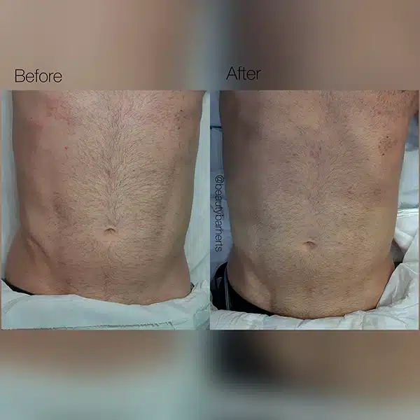 rf microneedling skin tightening for men buntingford Rf microneedling skin tightening for men buntingford