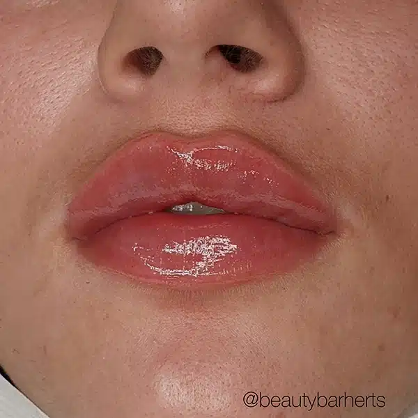 ware lip fillers Choosing your lip filler practitioner in Hertfordshire
